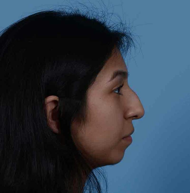 Rhinoplasty Before & After Gallery - Patient 363516 - Image 13