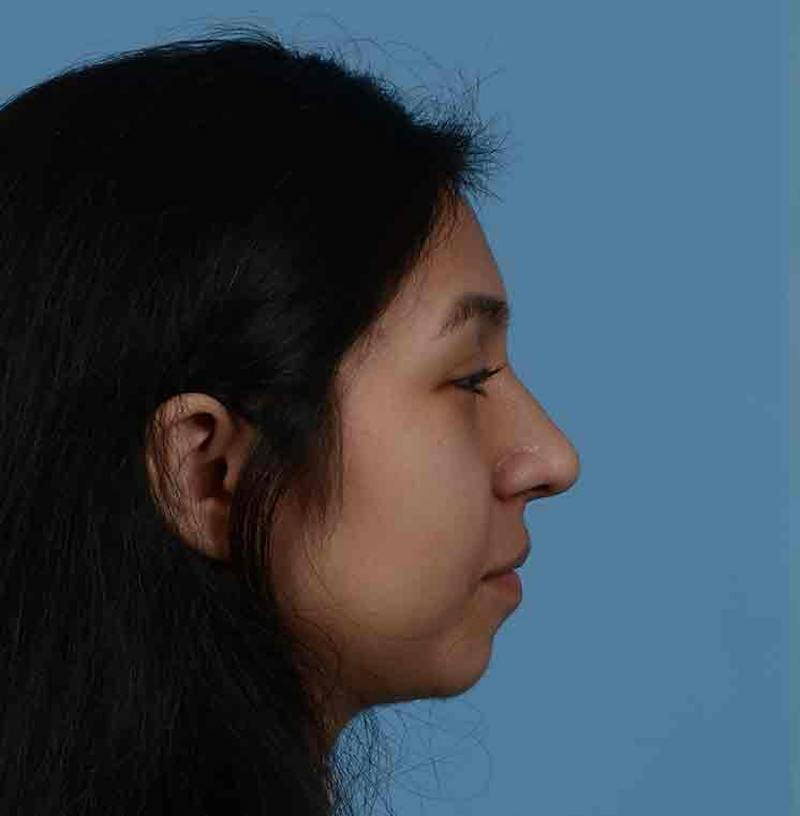 Rhinoplasty Before & After Gallery - Patient 363516 - Image 14