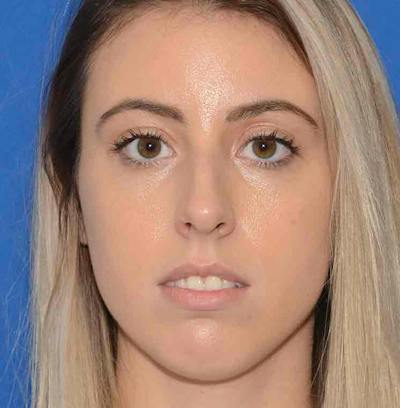 Rhinoplasty Before & After Gallery - Patient 421039 - Image 1