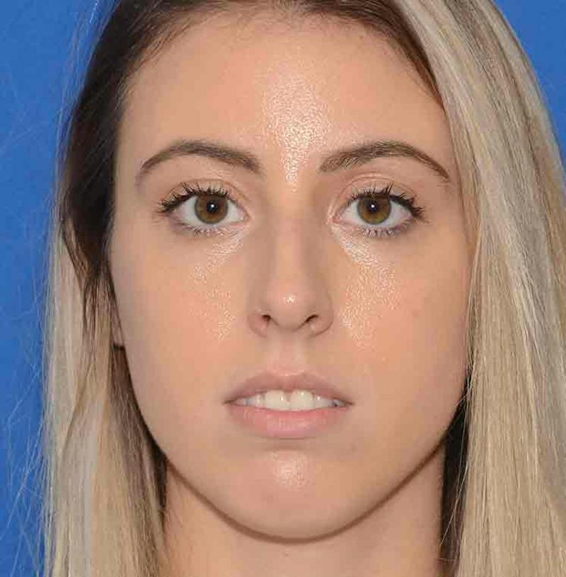 Rhinoplasty Before & After Gallery - Patient 421039 - Image 1