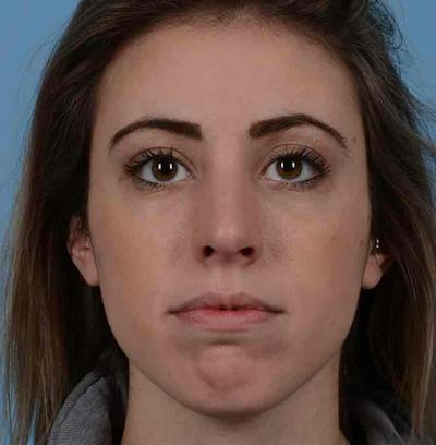 Rhinoplasty Before & After Gallery - Patient 421039 - Image 2