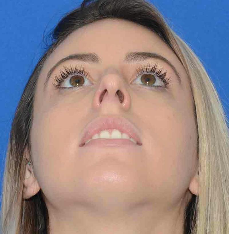 Rhinoplasty Before & After Gallery - Patient 421039 - Image 3