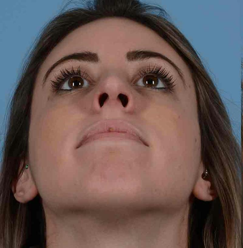 Rhinoplasty Before & After Gallery - Patient 421039 - Image 4