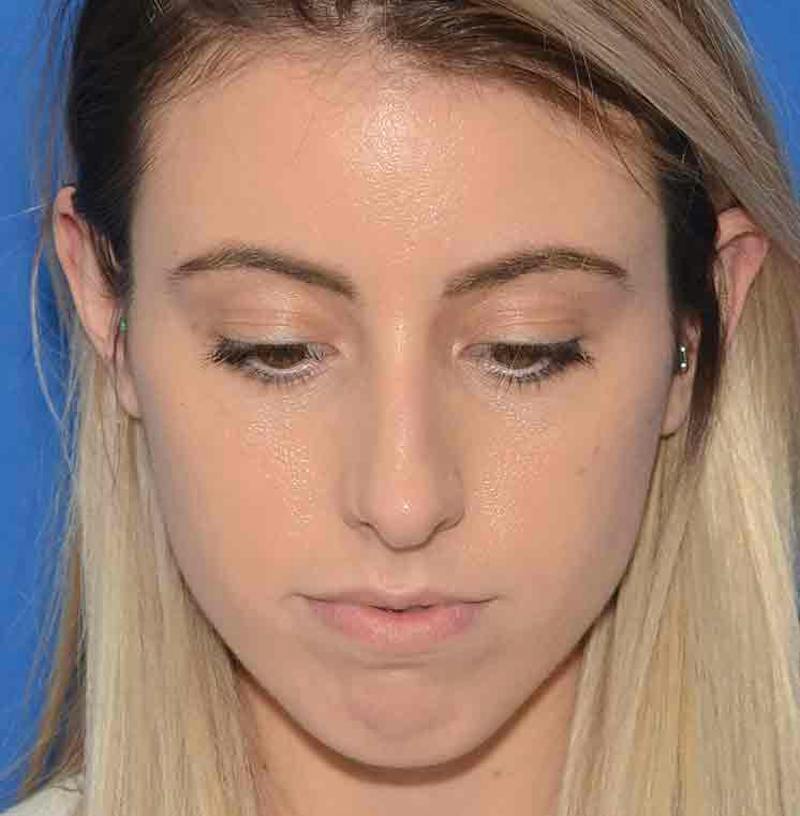 Rhinoplasty Before & After Gallery - Patient 421039 - Image 5