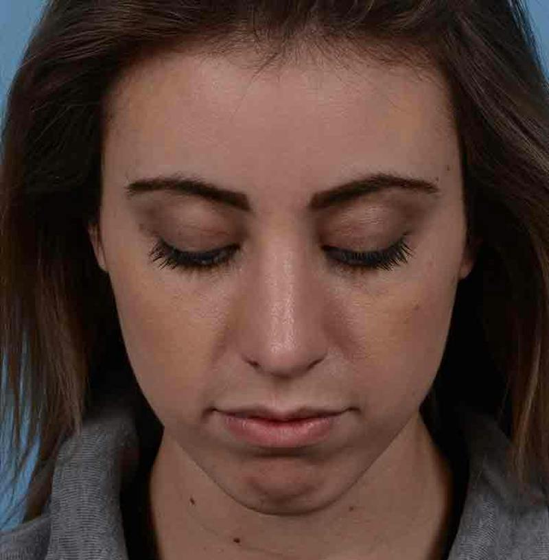 Rhinoplasty Before & After Gallery - Patient 421039 - Image 6