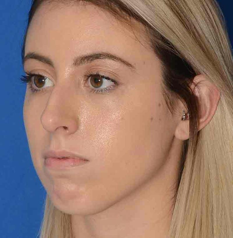 Rhinoplasty Before & After Gallery - Patient 421039 - Image 7