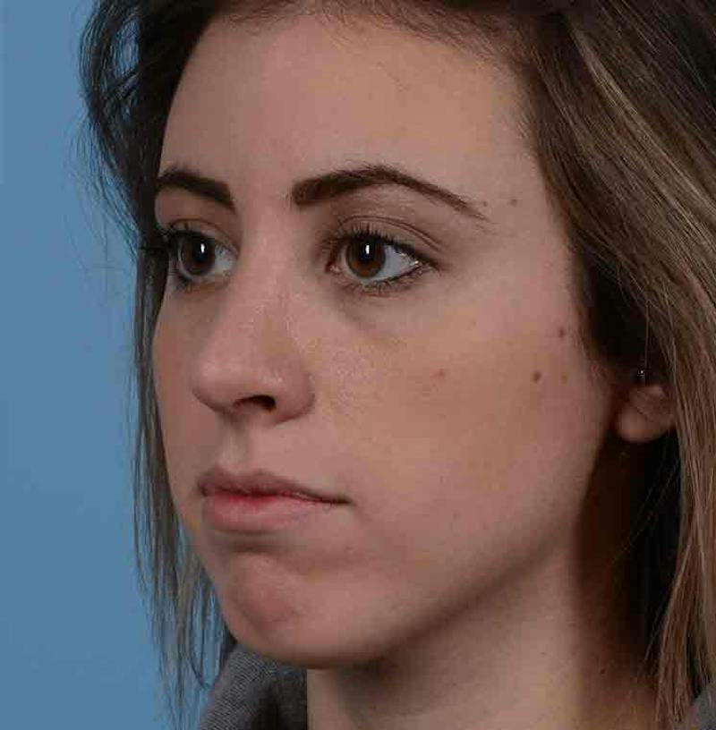 Rhinoplasty Before & After Gallery - Patient 421039 - Image 8