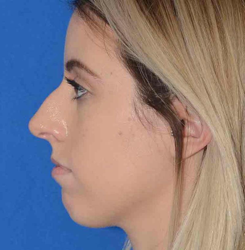 Rhinoplasty Before & After Gallery - Patient 421039 - Image 9