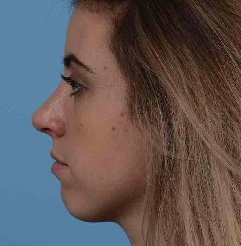 Rhinoplasty Before & After Gallery - Patient 421039 - Image 10