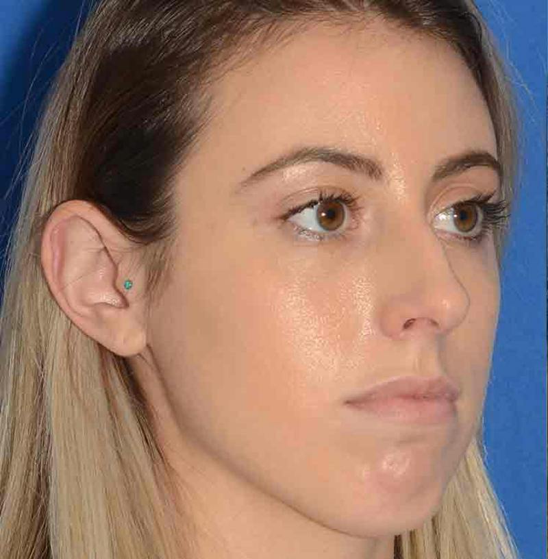 Rhinoplasty Before & After Gallery - Patient 421039 - Image 11