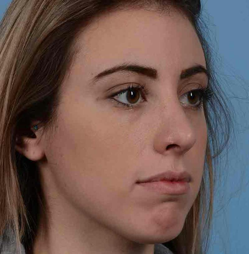 Rhinoplasty Before & After Gallery - Patient 421039 - Image 12