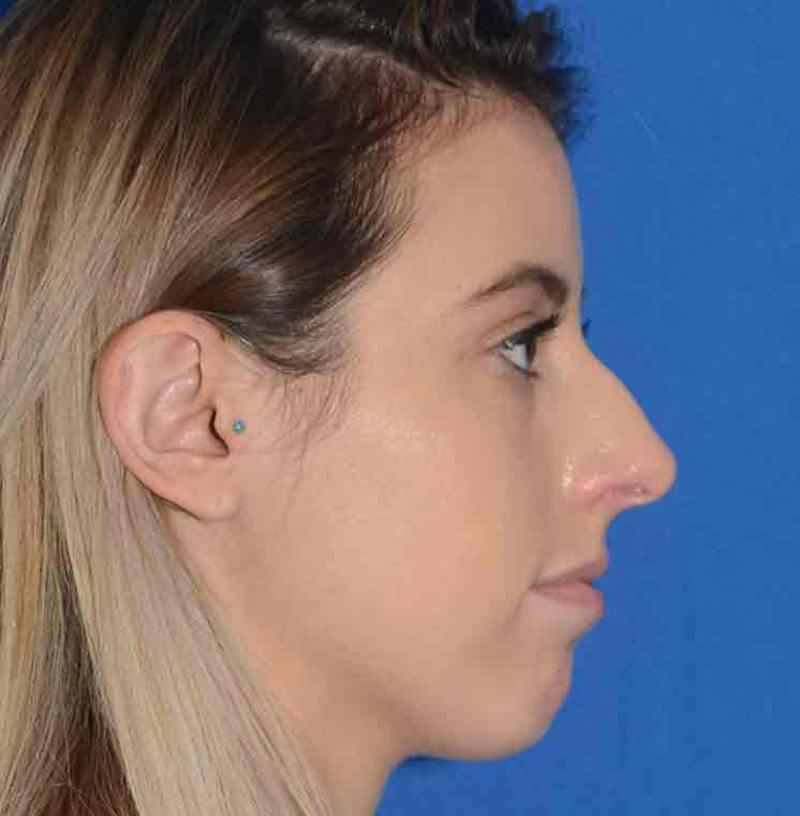 Rhinoplasty Before & After Gallery - Patient 421039 - Image 13
