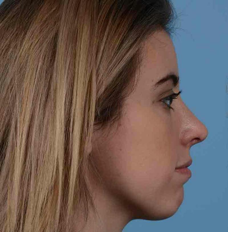 Rhinoplasty Before & After Gallery - Patient 421039 - Image 14