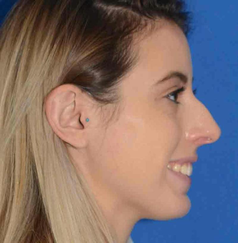 Rhinoplasty Before & After Gallery - Patient 421039 - Image 15