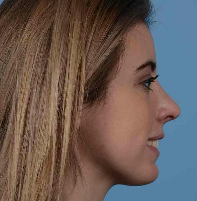 Rhinoplasty Before & After Gallery - Patient 421039 - Image 16