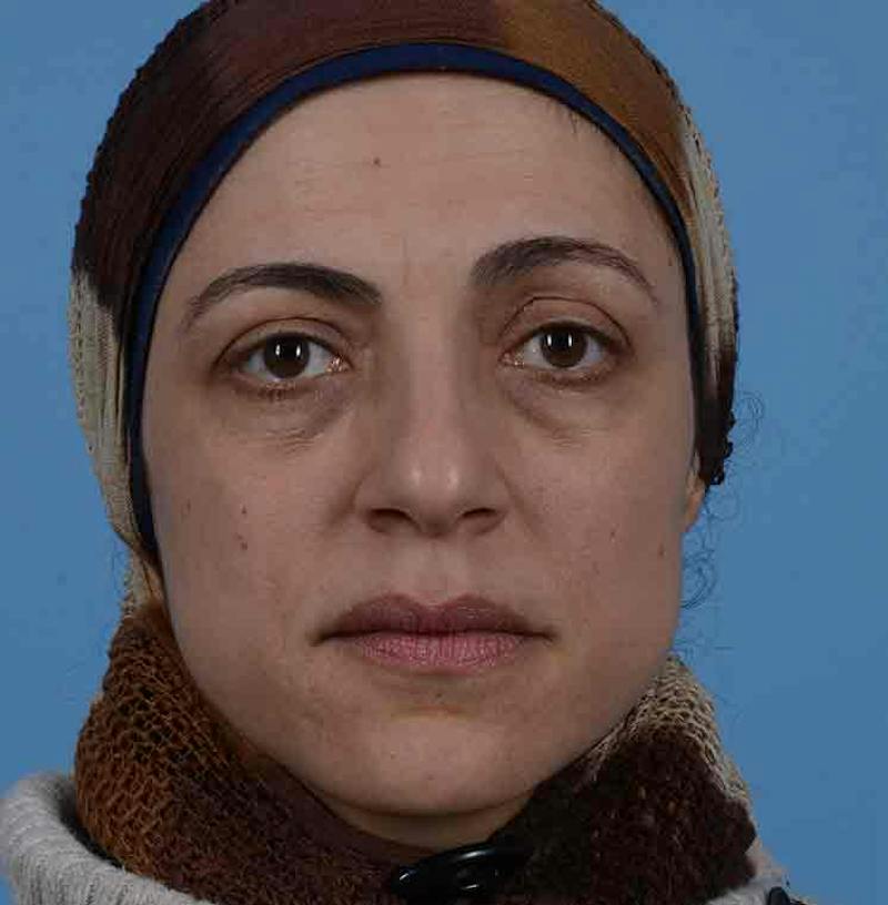 Rhinoplasty Before & After Gallery - Patient 171554 - Image 1