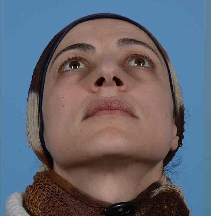Rhinoplasty Before & After Gallery - Patient 171554 - Image 3