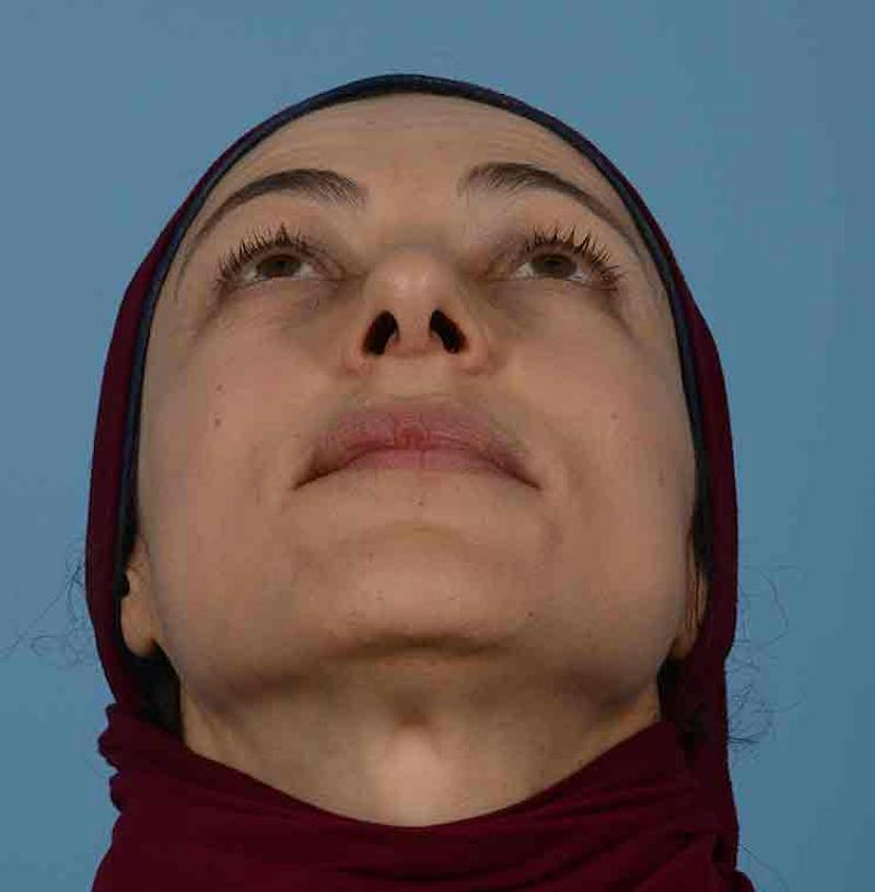 Rhinoplasty Before & After Gallery - Patient 171554 - Image 4