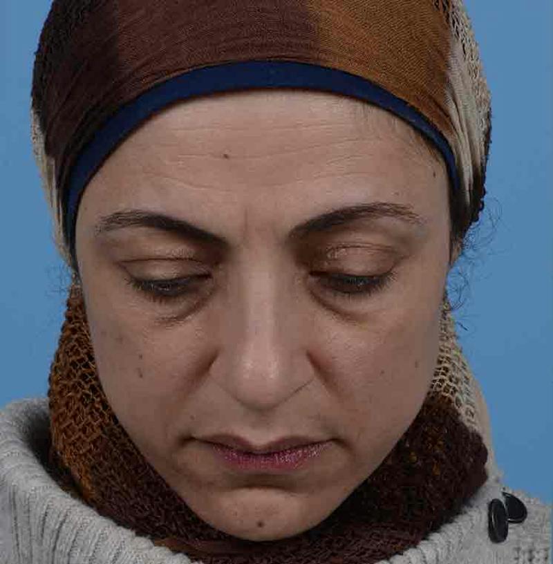 Rhinoplasty Before & After Gallery - Patient 171554 - Image 5