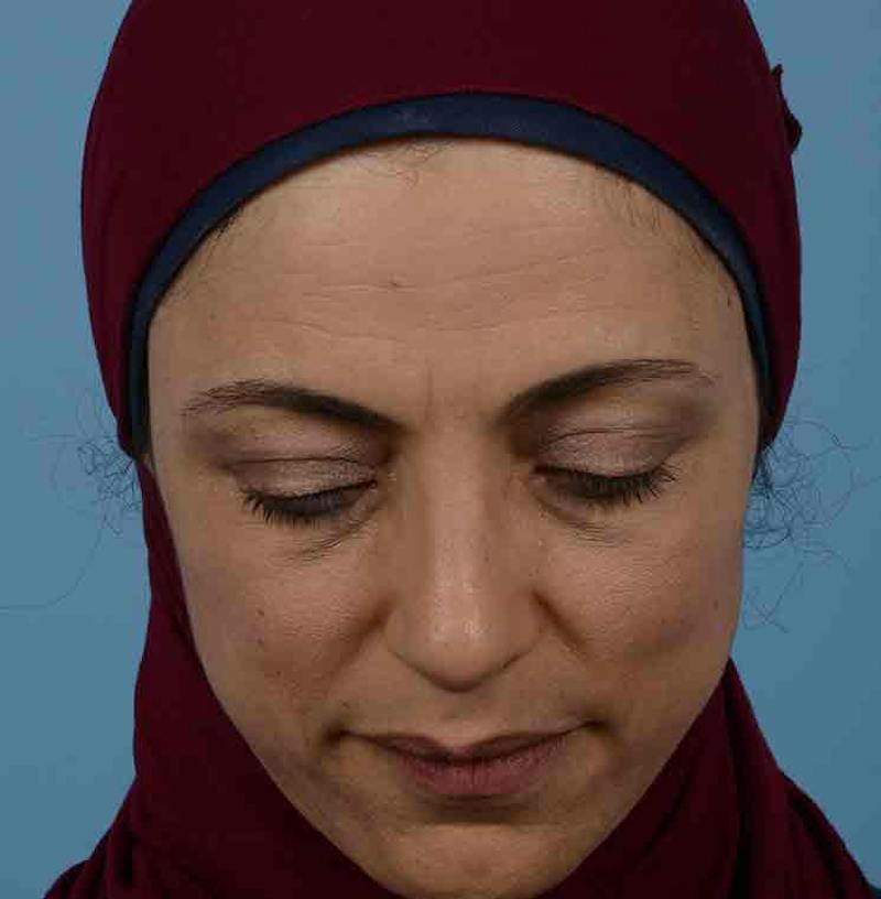 Rhinoplasty Before & After Gallery - Patient 171554 - Image 6