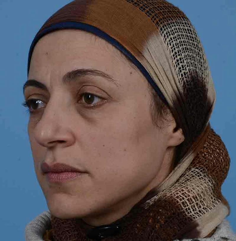 Rhinoplasty Before & After Gallery - Patient 171554 - Image 7