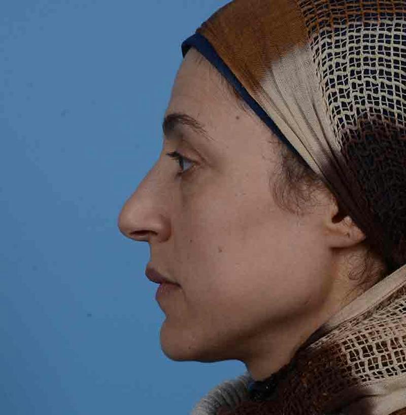 Rhinoplasty Before & After Gallery - Patient 171554 - Image 9