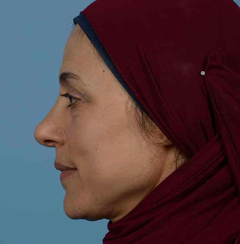 Rhinoplasty Before & After Gallery - Patient 171554 - Image 10