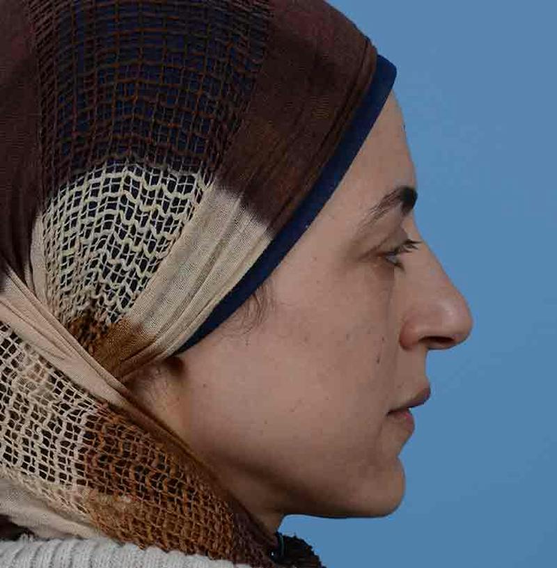 Rhinoplasty Before & After Gallery - Patient 171554 - Image 13
