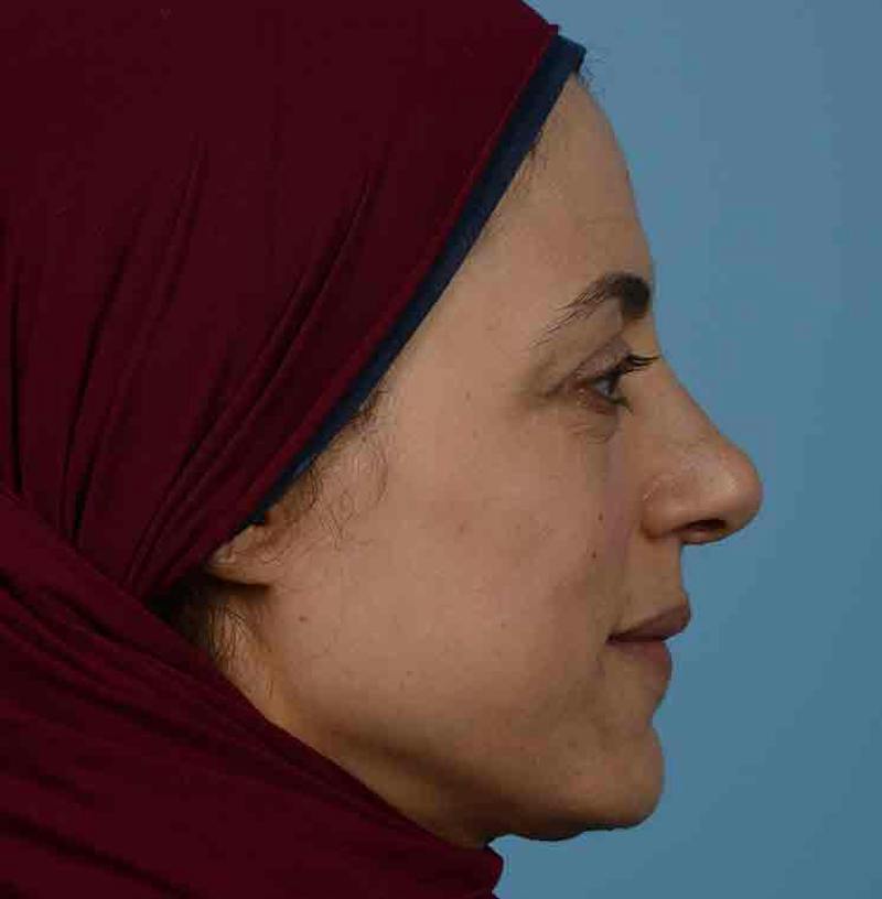 Rhinoplasty Before & After Gallery - Patient 171554 - Image 14