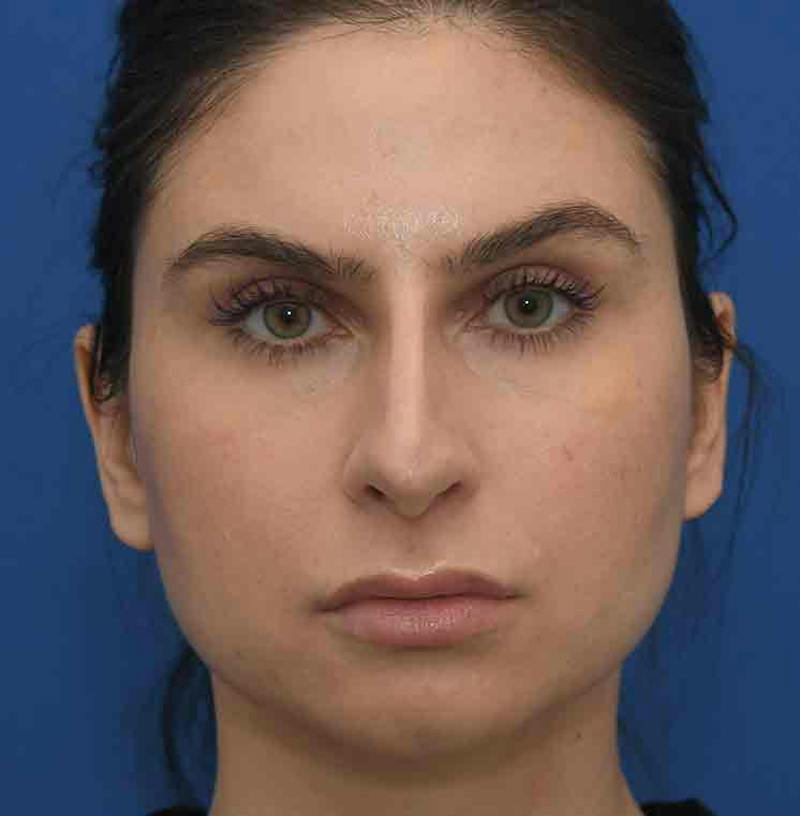 Rhinoplasty Before & After Gallery - Patient 348711 - Image 1