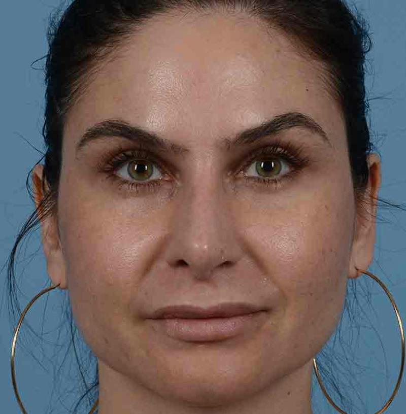 Rhinoplasty Before & After Gallery - Patient 348711 - Image 2