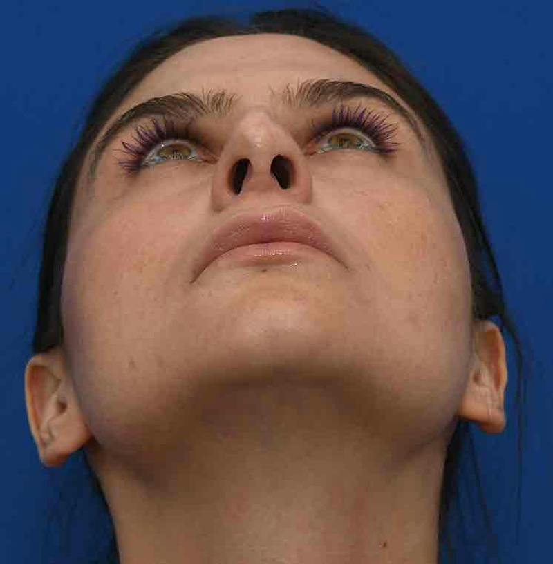 Rhinoplasty Before & After Gallery - Patient 348711 - Image 3