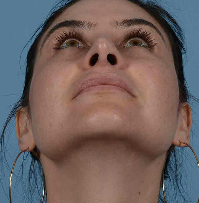 Rhinoplasty Before & After Gallery - Patient 348711 - Image 4