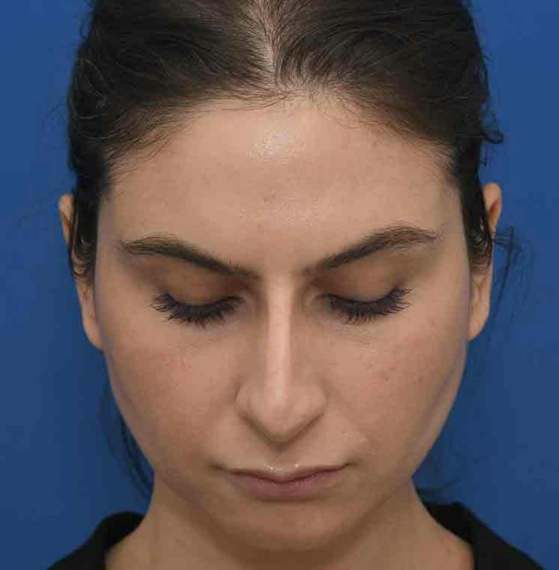 Rhinoplasty Before & After Gallery - Patient 348711 - Image 5