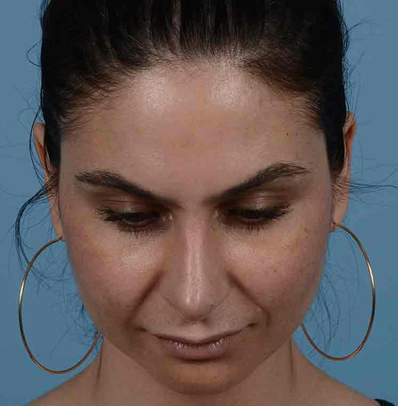 Rhinoplasty Before & After Gallery - Patient 348711 - Image 6