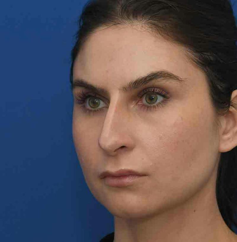 Rhinoplasty Before & After Gallery - Patient 348711 - Image 7