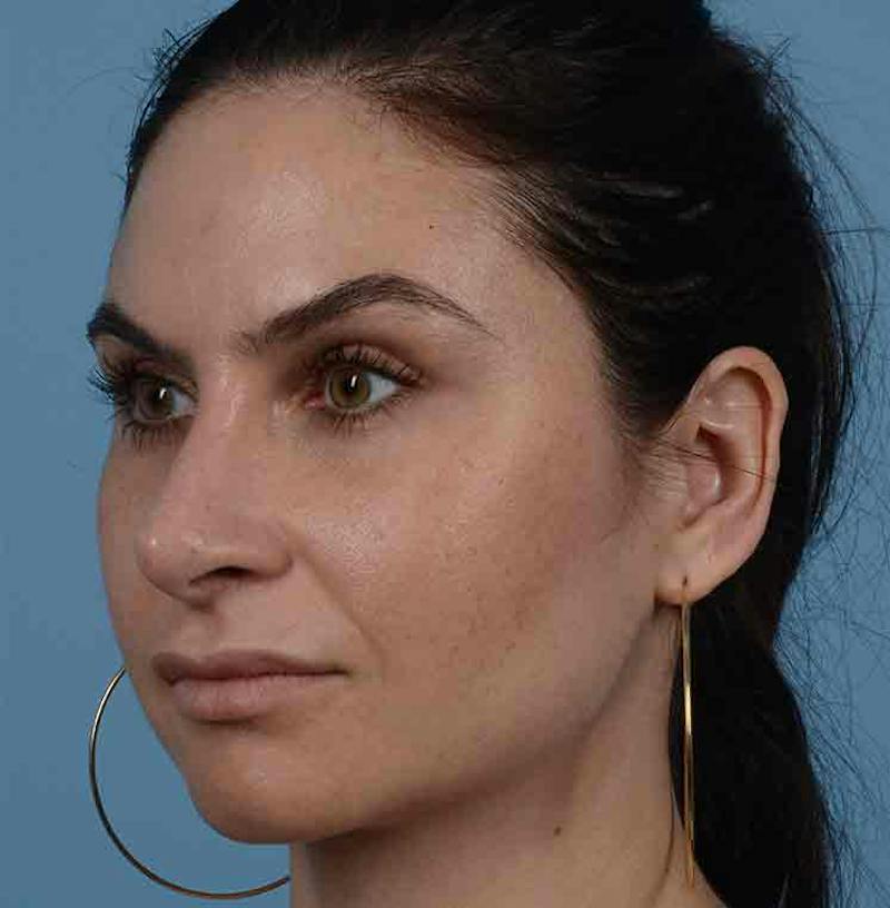 Rhinoplasty Before & After Gallery - Patient 348711 - Image 8