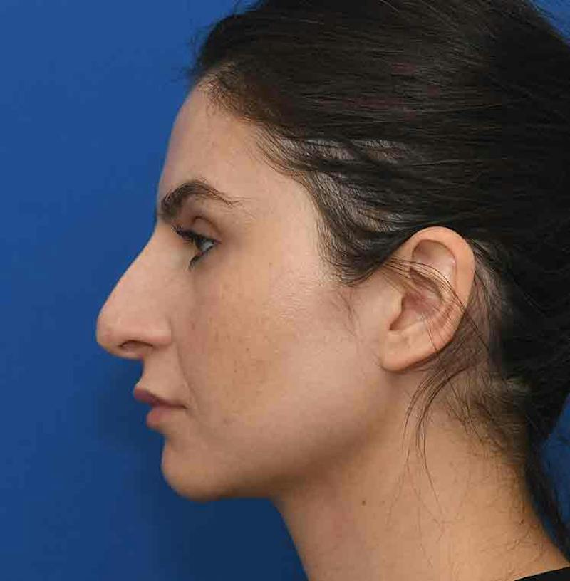 Rhinoplasty Before & After Gallery - Patient 348711 - Image 9