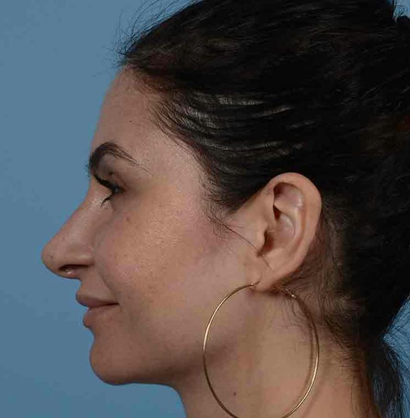 Rhinoplasty Before & After Gallery - Patient 348711 - Image 10