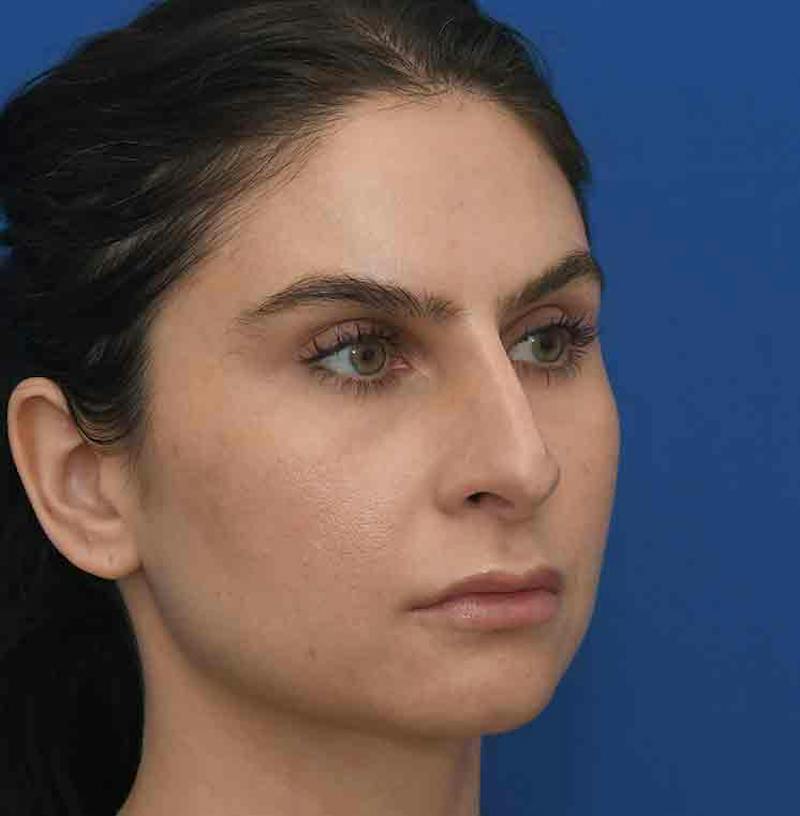 Rhinoplasty Before & After Gallery - Patient 348711 - Image 11