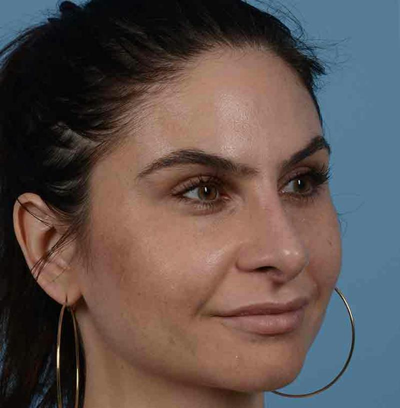 Rhinoplasty Before & After Gallery - Patient 348711 - Image 12