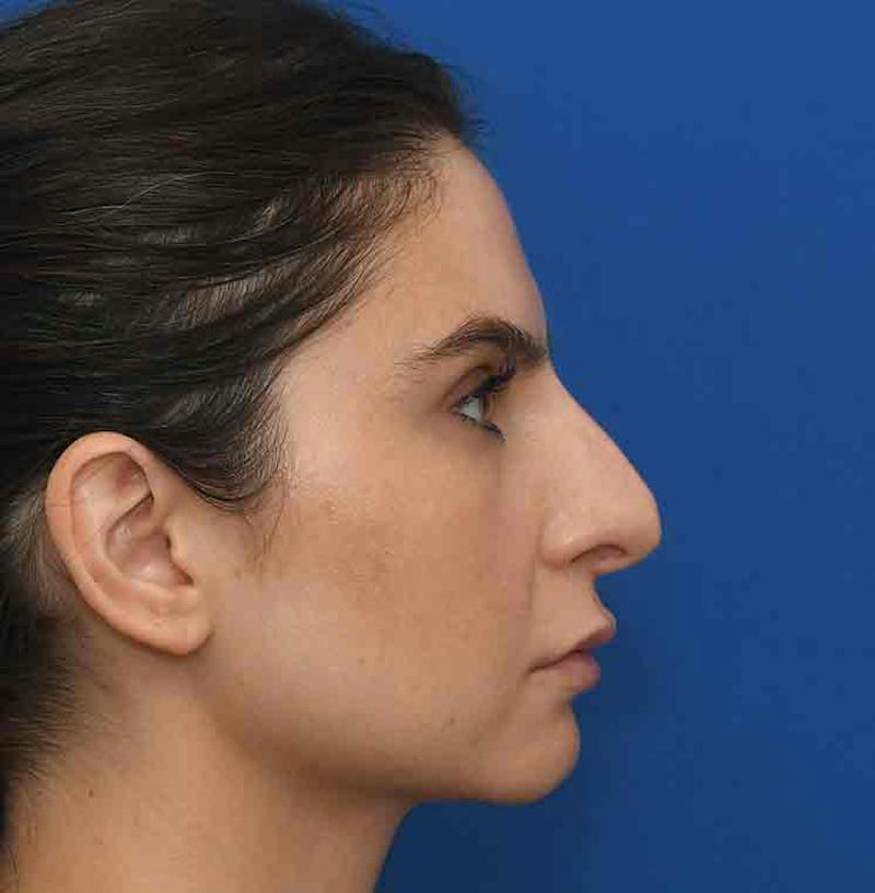 Rhinoplasty Before & After Gallery - Patient 348711 - Image 13