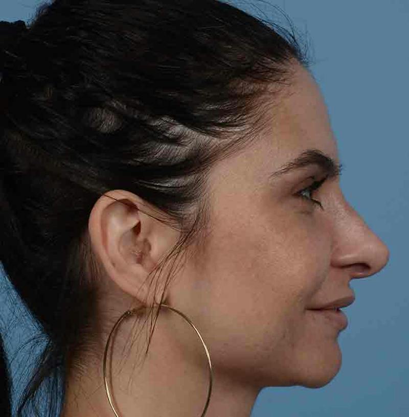 Rhinoplasty Before & After Gallery - Patient 348711 - Image 14