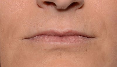 Lips Before & After Gallery - Patient 111664 - Image 1