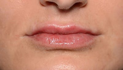 Lips Before & After Gallery - Patient 111664 - Image 2