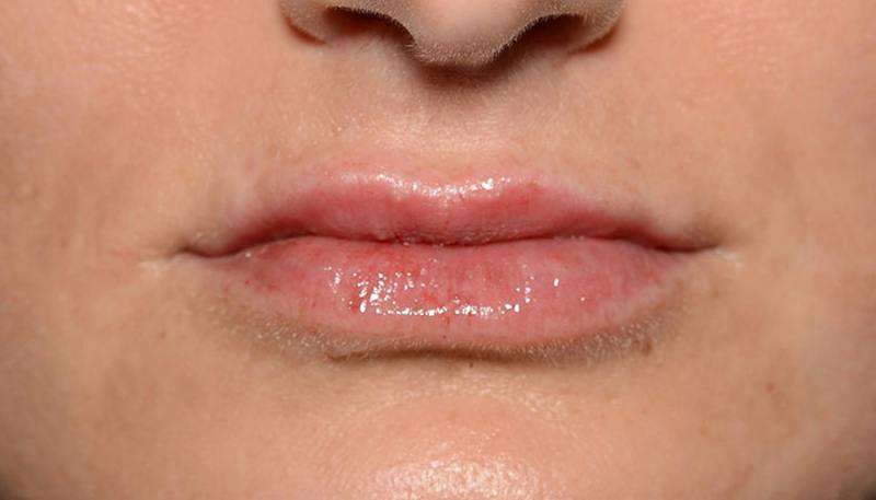 Lips Before & After Gallery - Patient 111664 - Image 2