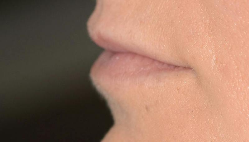 Lips Before & After Gallery - Patient 111664 - Image 3