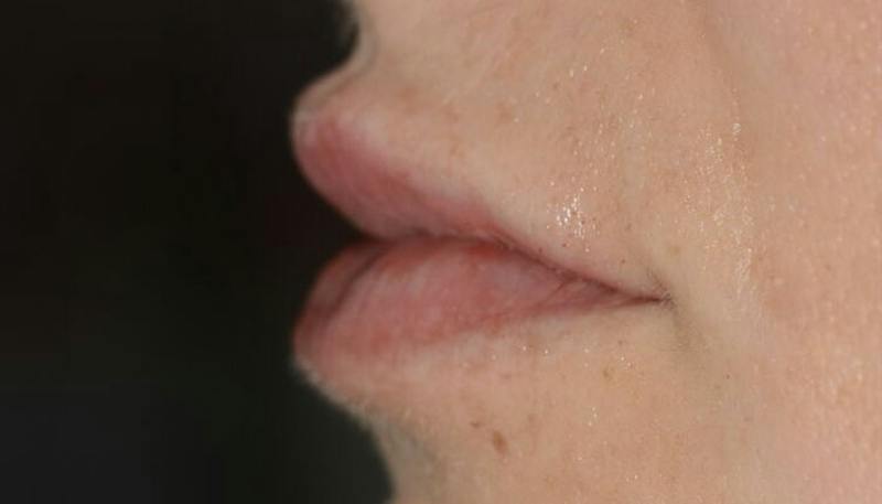 Lips Before & After Gallery - Patient 111664 - Image 4