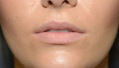 Lips Before & After Gallery - Patient 337694 - Image 1