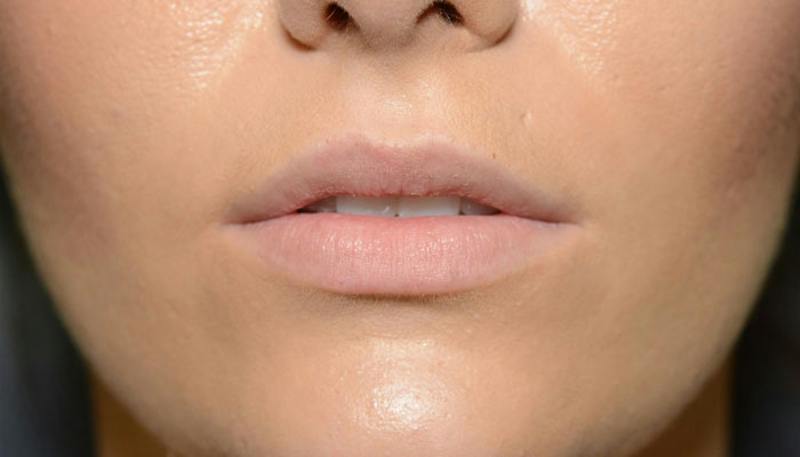Lips Before & After Gallery - Patient 337694 - Image 1